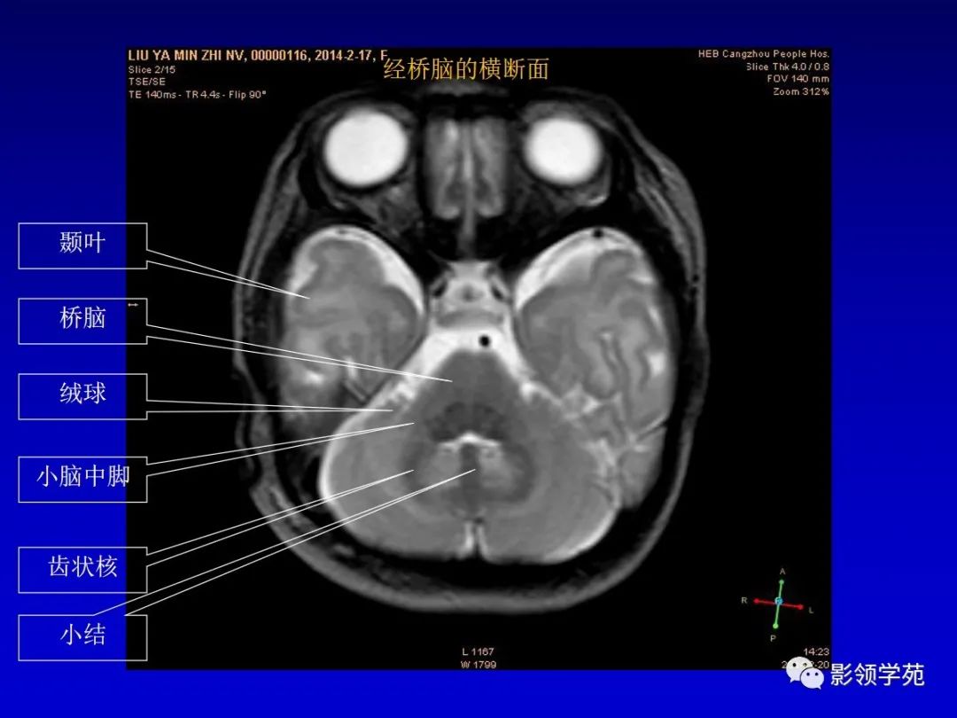 影像PPT - 新生儿颅脑MRI解剖及常见疾病影像表现-44 影像PPT - 新生儿颅脑MRI解剖及常见疾病影像表现-44