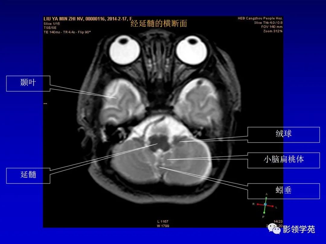 影像PPT - 新生儿颅脑MRI解剖及常见疾病影像表现-45 影像PPT - 新生儿颅脑MRI解剖及常见疾病影像表现-45