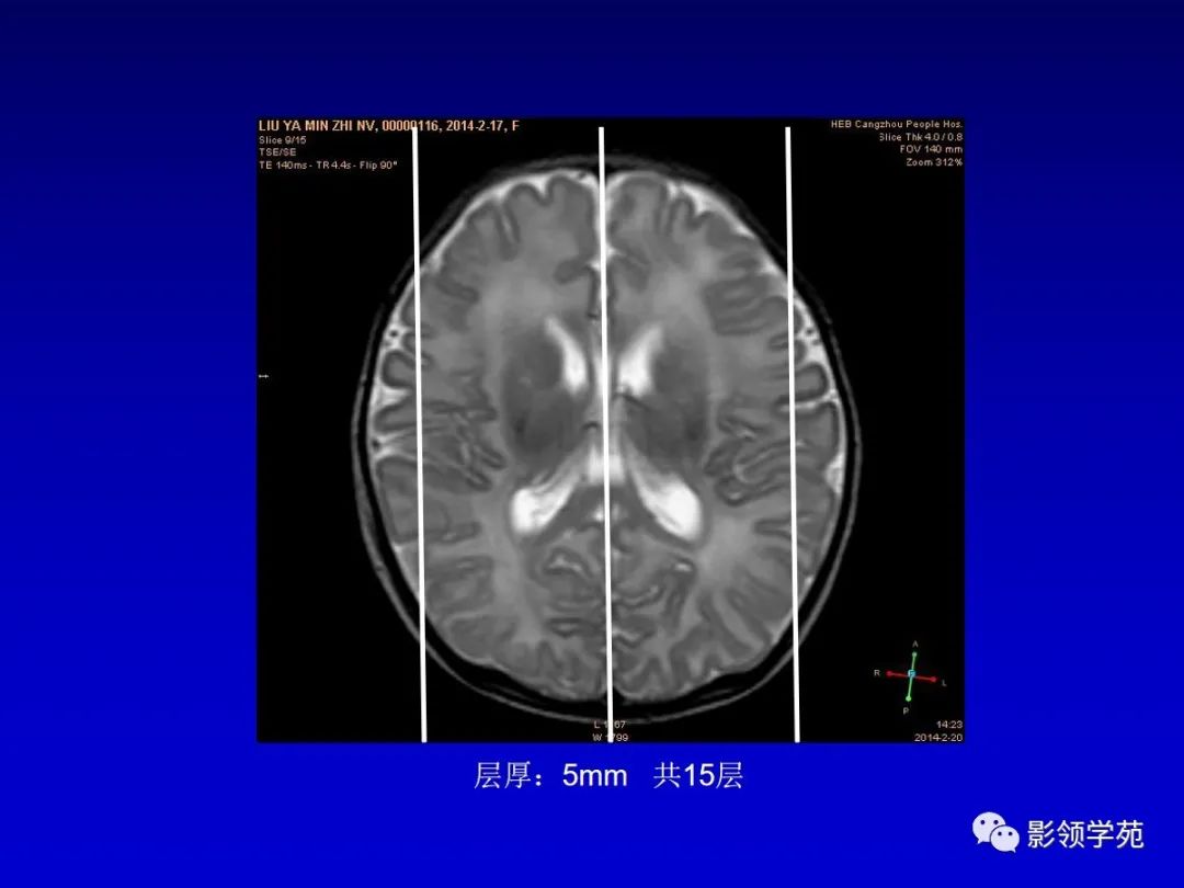 影像PPT - 新生儿颅脑MRI解剖及常见疾病影像表现-47 影像PPT - 新生儿颅脑MRI解剖及常见疾病影像表现-47
