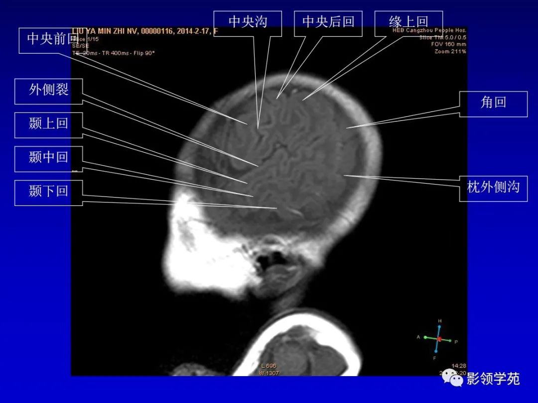 影像PPT - 新生儿颅脑MRI解剖及常见疾病影像表现-48 影像PPT - 新生儿颅脑MRI解剖及常见疾病影像表现-48
