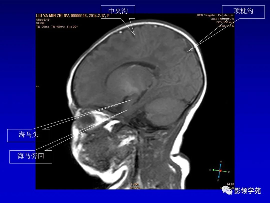 影像PPT - 新生儿颅脑MRI解剖及常见疾病影像表现-53 影像PPT - 新生儿颅脑MRI解剖及常见疾病影像表现-53