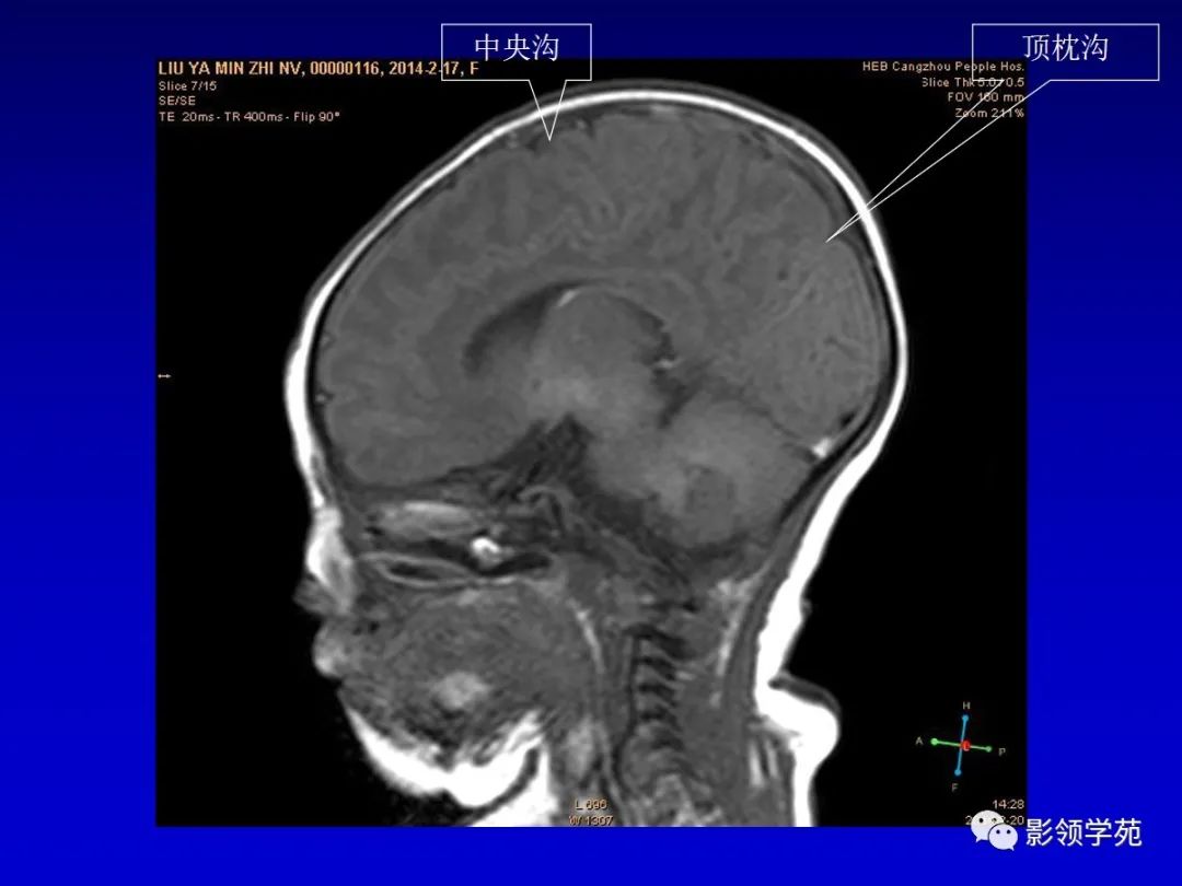 影像PPT - 新生儿颅脑MRI解剖及常见疾病影像表现-54 影像PPT - 新生儿颅脑MRI解剖及常见疾病影像表现-54