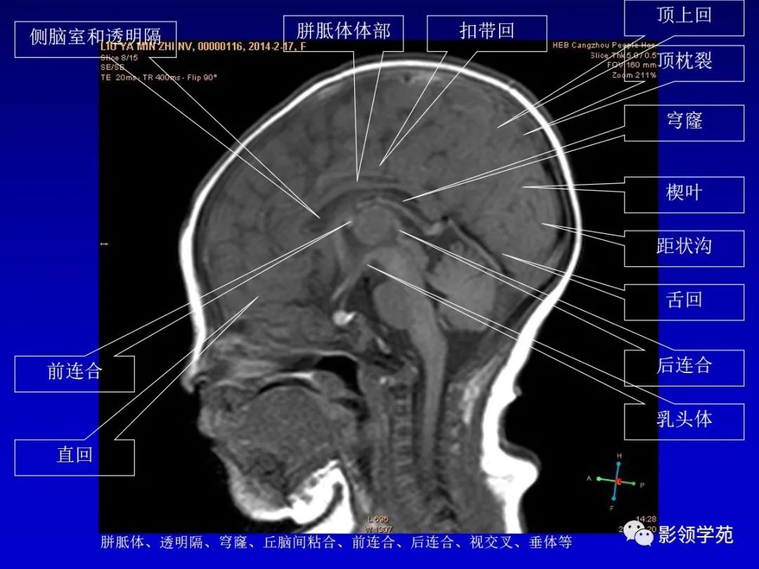 影像PPT - 新生儿颅脑MRI解剖及常见疾病影像表现-55 影像PPT - 新生儿颅脑MRI解剖及常见疾病影像表现-55
