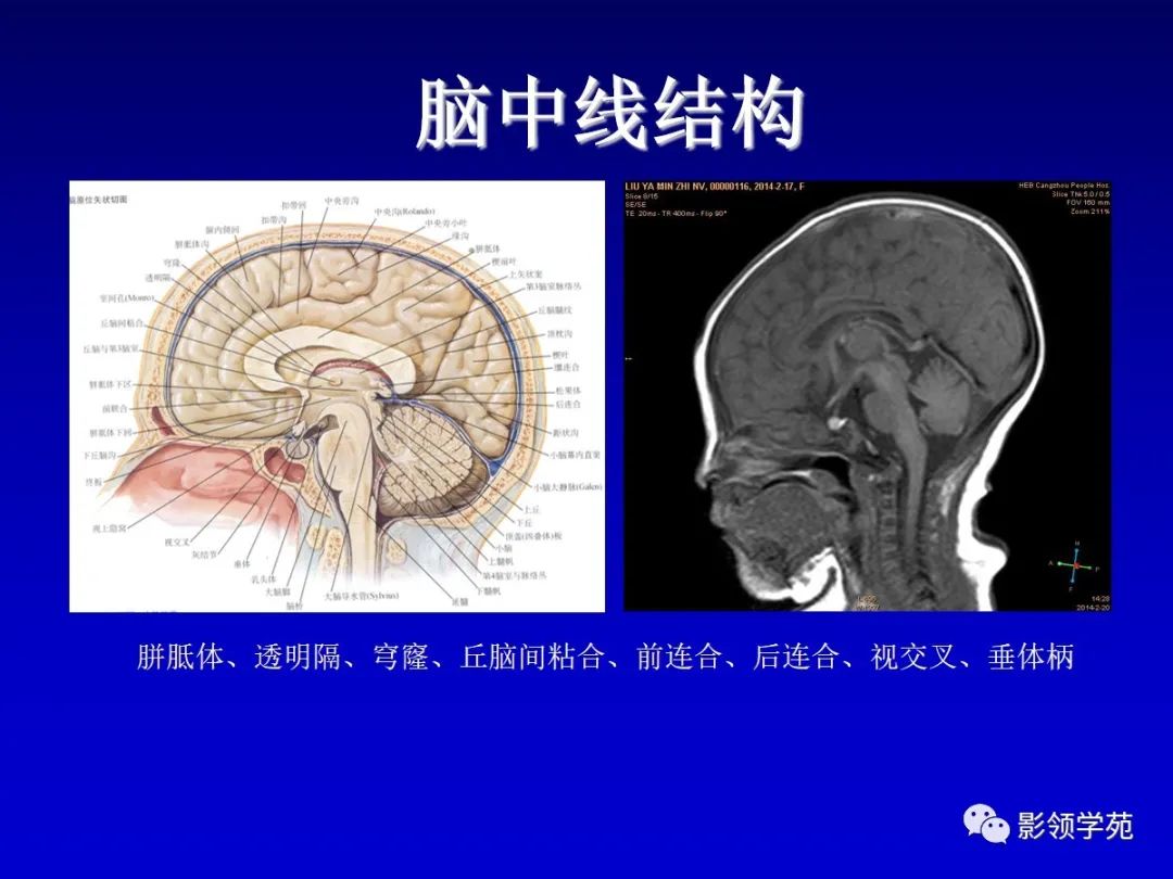 影像PPT - 新生儿颅脑MRI解剖及常见疾病影像表现-56 影像PPT - 新生儿颅脑MRI解剖及常见疾病影像表现-56