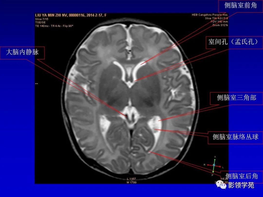 影像PPT - 新生儿颅脑MRI解剖及常见疾病影像表现-70 影像PPT - 新生儿颅脑MRI解剖及常见疾病影像表现-70