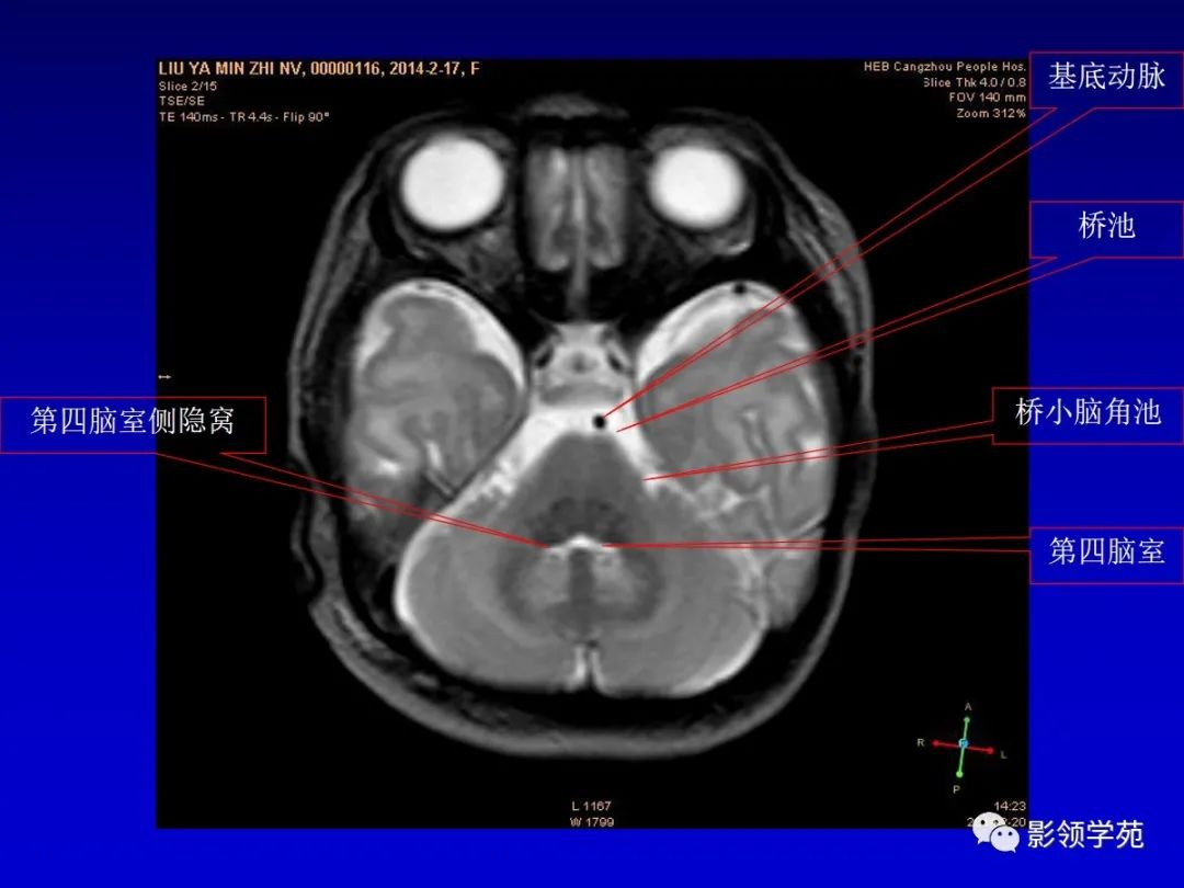 影像PPT - 新生儿颅脑MRI解剖及常见疾病影像表现-73 影像PPT - 新生儿颅脑MRI解剖及常见疾病影像表现-73