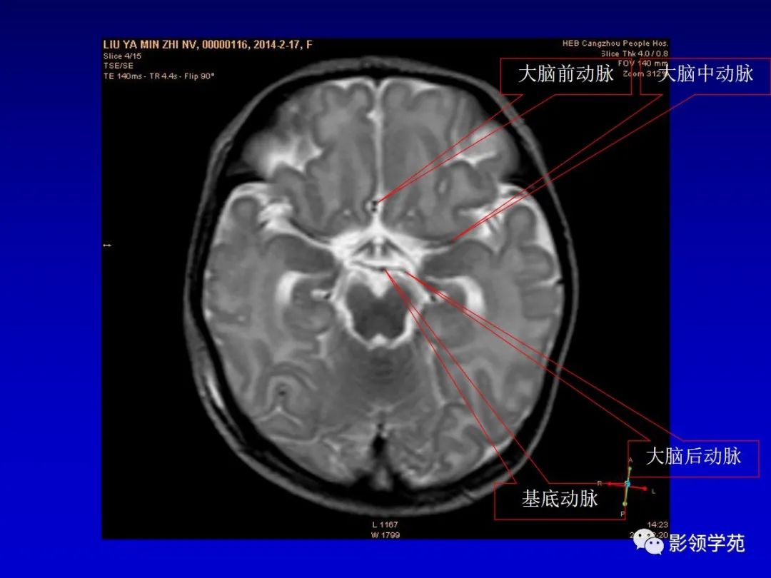 影像PPT - 新生儿颅脑MRI解剖及常见疾病影像表现-80 影像PPT - 新生儿颅脑MRI解剖及常见疾病影像表现-80