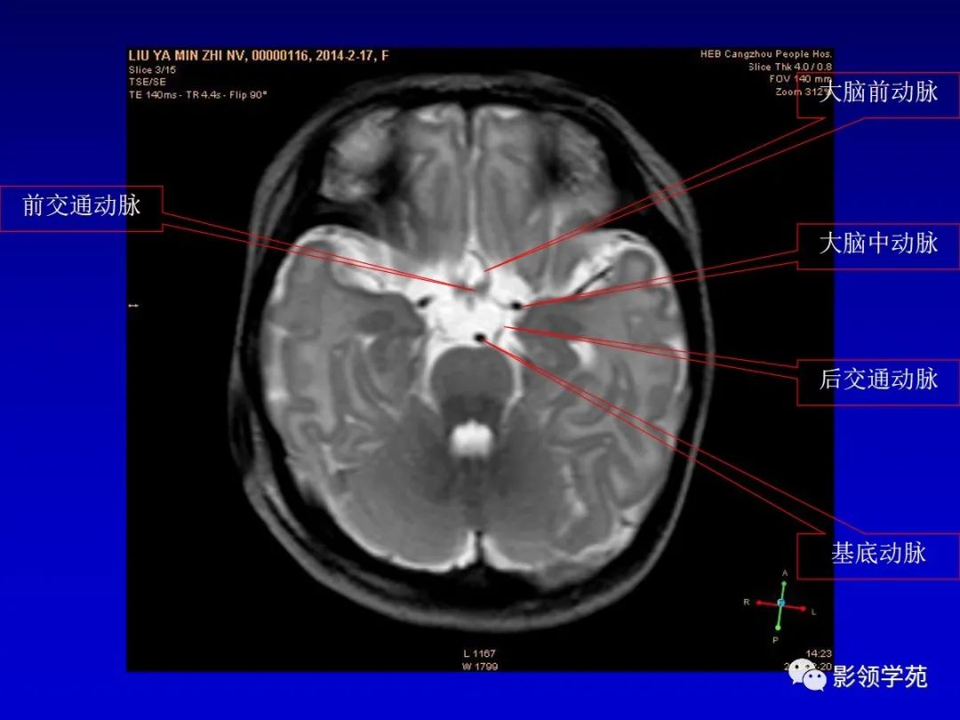 影像PPT - 新生儿颅脑MRI解剖及常见疾病影像表现-81 影像PPT - 新生儿颅脑MRI解剖及常见疾病影像表现-81