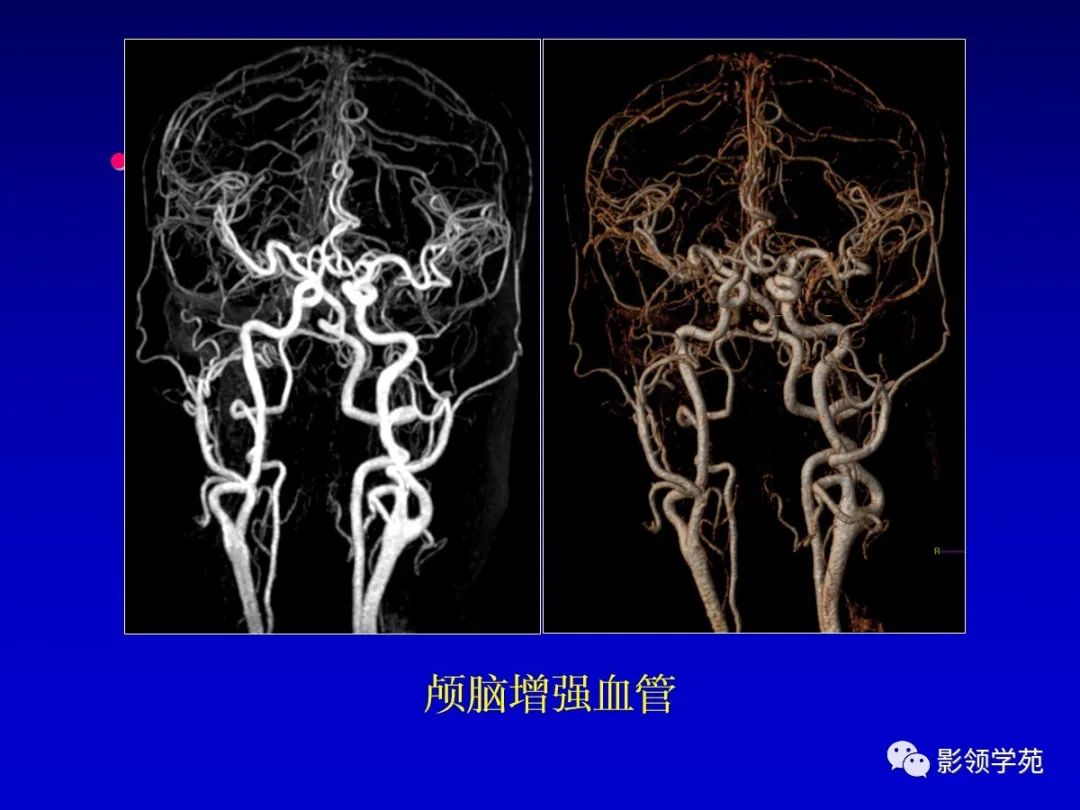 影像PPT - 新生儿颅脑MRI解剖及常见疾病影像表现-85 影像PPT - 新生儿颅脑MRI解剖及常见疾病影像表现-85