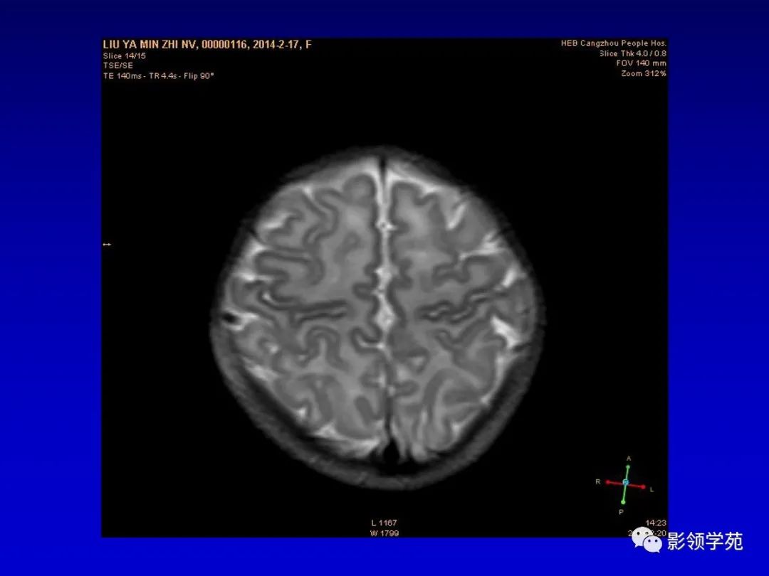 影像PPT - 新生儿颅脑MRI解剖及常见疾病影像表现-88 影像PPT - 新生儿颅脑MRI解剖及常见疾病影像表现-88