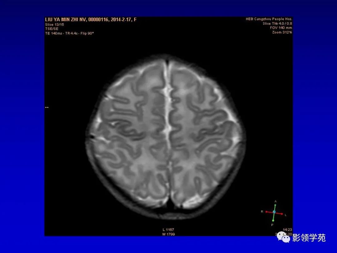 影像PPT - 新生儿颅脑MRI解剖及常见疾病影像表现-89 影像PPT - 新生儿颅脑MRI解剖及常见疾病影像表现-89