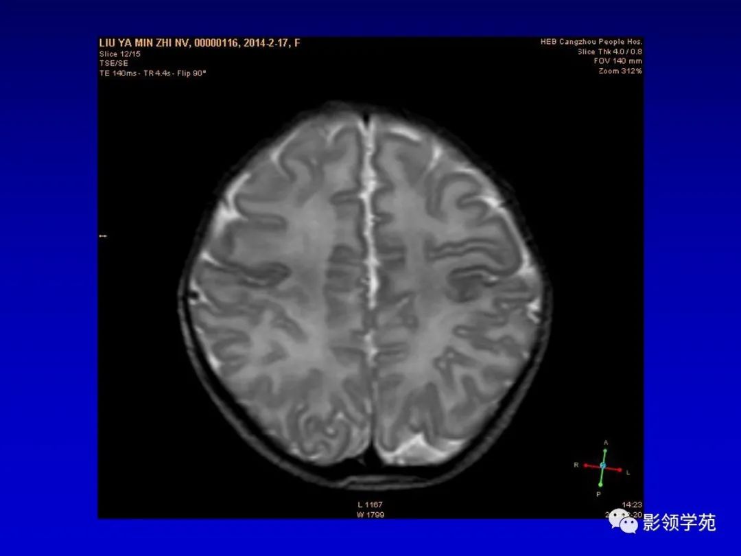 影像PPT - 新生儿颅脑MRI解剖及常见疾病影像表现-90 影像PPT - 新生儿颅脑MRI解剖及常见疾病影像表现-90