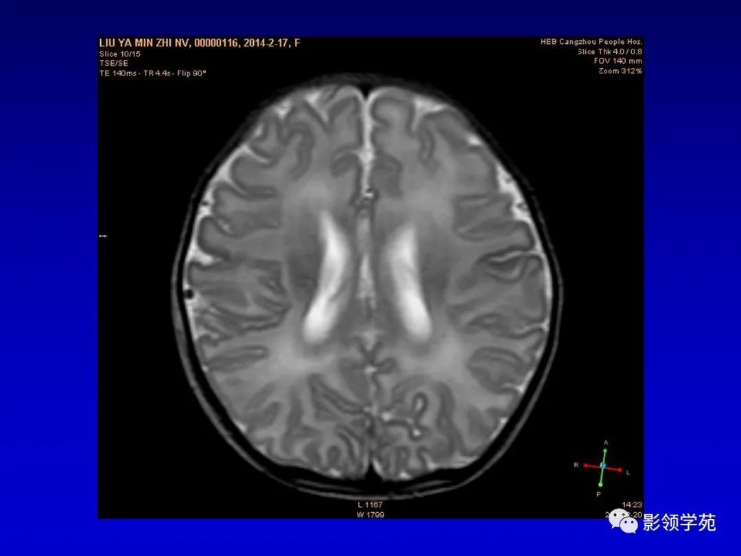 影像PPT - 新生儿颅脑MRI解剖及常见疾病影像表现-92 影像PPT - 新生儿颅脑MRI解剖及常见疾病影像表现-92