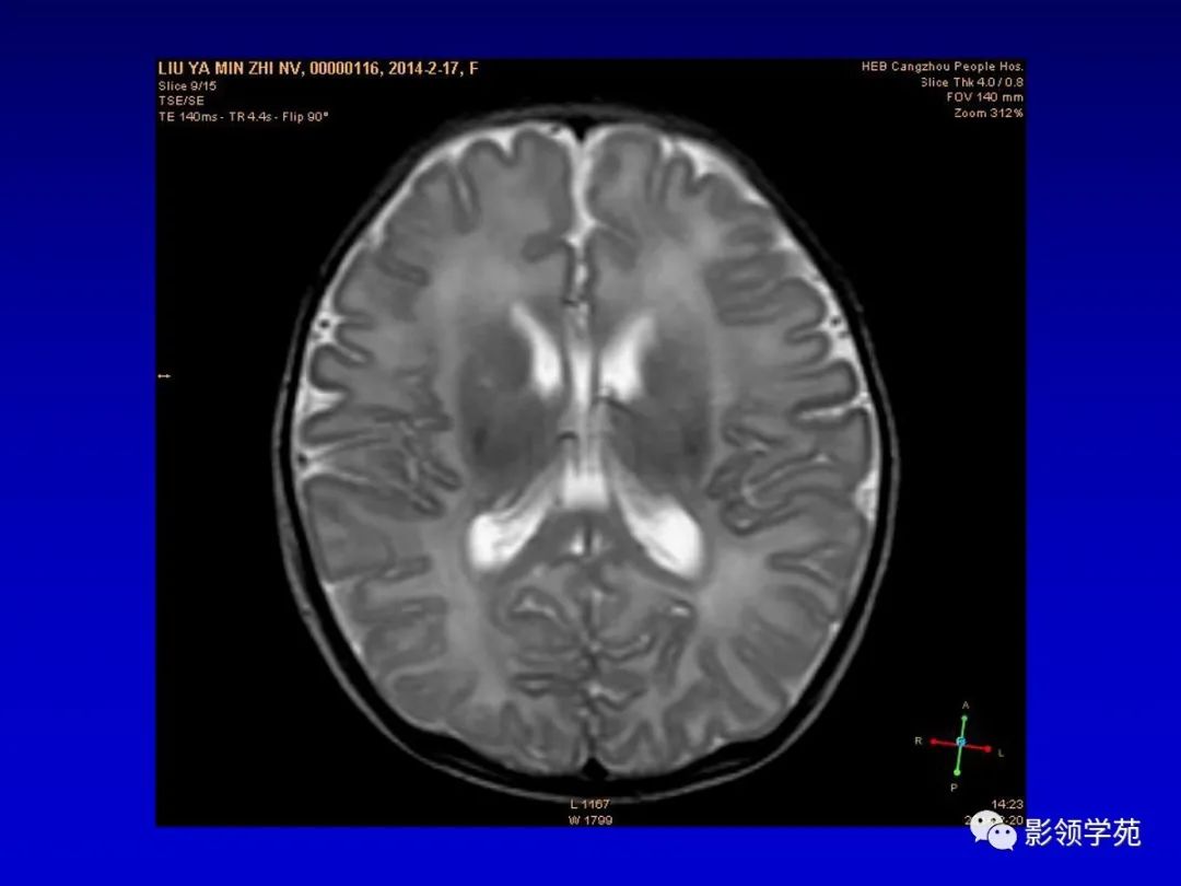 影像PPT - 新生儿颅脑MRI解剖及常见疾病影像表现-93 影像PPT - 新生儿颅脑MRI解剖及常见疾病影像表现-93