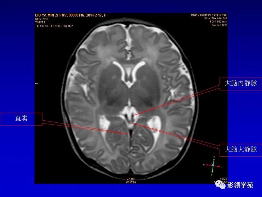 影像PPT - 新生儿颅脑MRI解剖及常见疾病影像表现-95 影像PPT - 新生儿颅脑MRI解剖及常见疾病影像表现-95