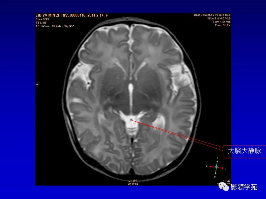 影像PPT - 新生儿颅脑MRI解剖及常见疾病影像表现-96 影像PPT - 新生儿颅脑MRI解剖及常见疾病影像表现-96