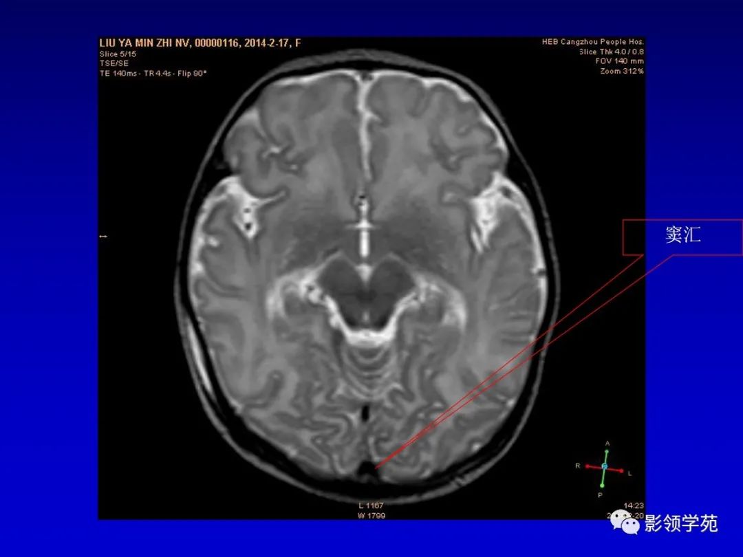 影像PPT - 新生儿颅脑MRI解剖及常见疾病影像表现-97 影像PPT - 新生儿颅脑MRI解剖及常见疾病影像表现-97
