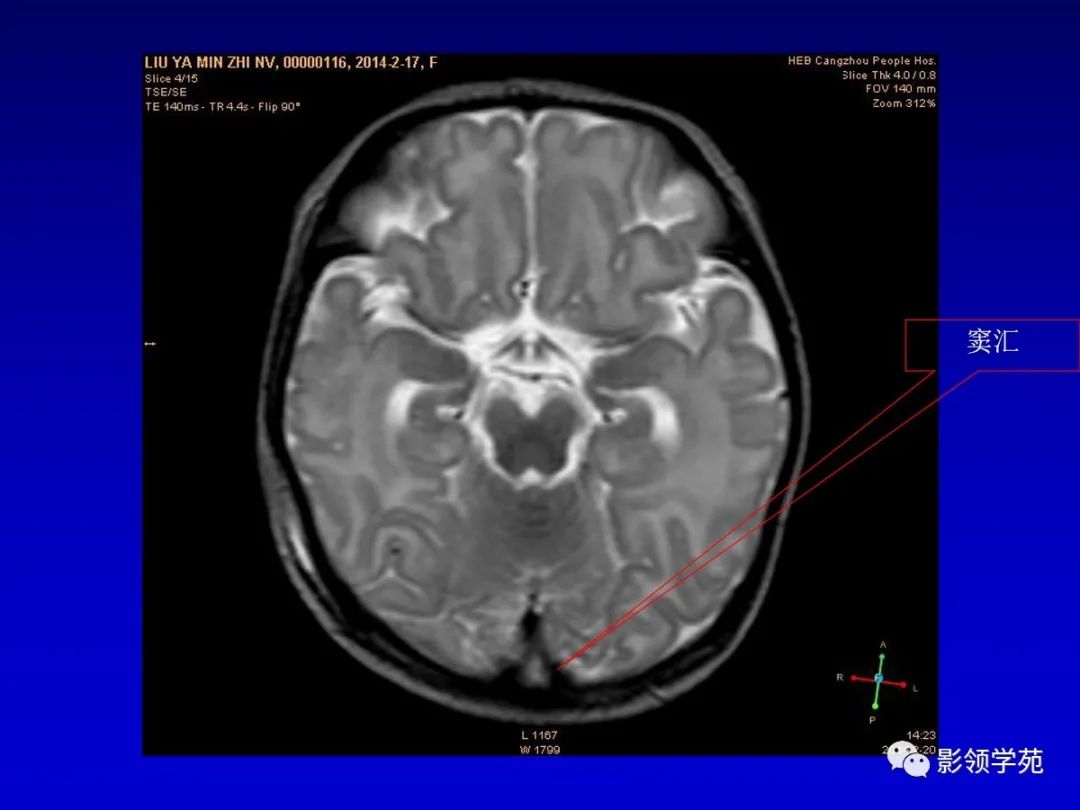 影像PPT - 新生儿颅脑MRI解剖及常见疾病影像表现-98 影像PPT - 新生儿颅脑MRI解剖及常见疾病影像表现-98