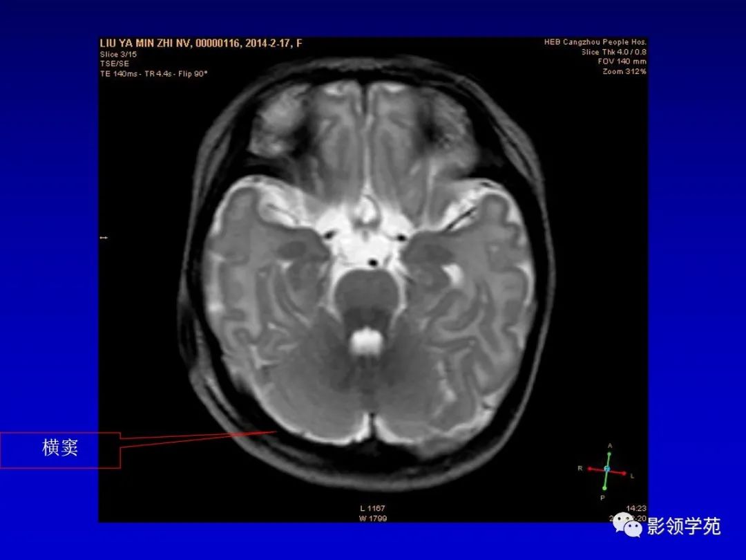 影像PPT - 新生儿颅脑MRI解剖及常见疾病影像表现-99 影像PPT - 新生儿颅脑MRI解剖及常见疾病影像表现-99