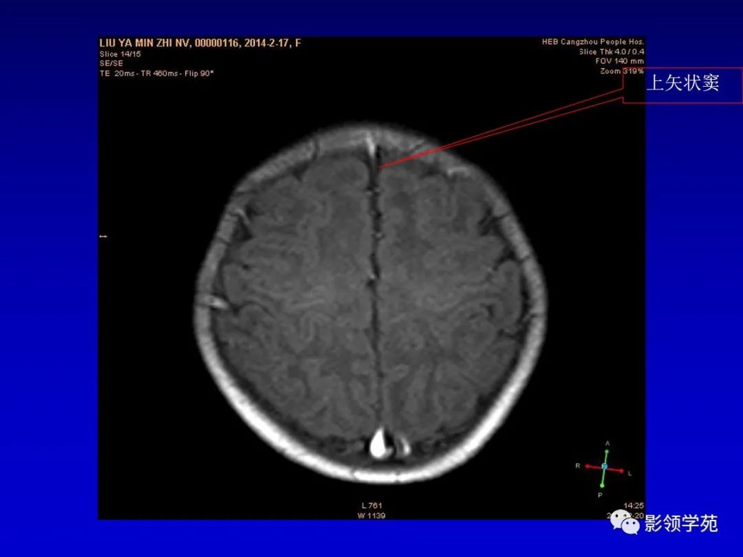 影像PPT - 新生儿颅脑MRI解剖及常见疾病影像表现-104 影像PPT - 新生儿颅脑MRI解剖及常见疾病影像表现-104