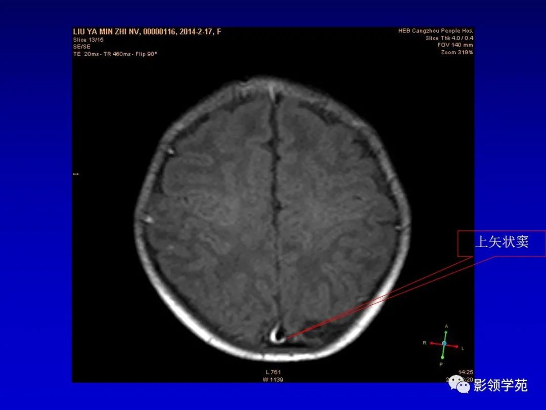 影像PPT - 新生儿颅脑MRI解剖及常见疾病影像表现-105 影像PPT - 新生儿颅脑MRI解剖及常见疾病影像表现-105
