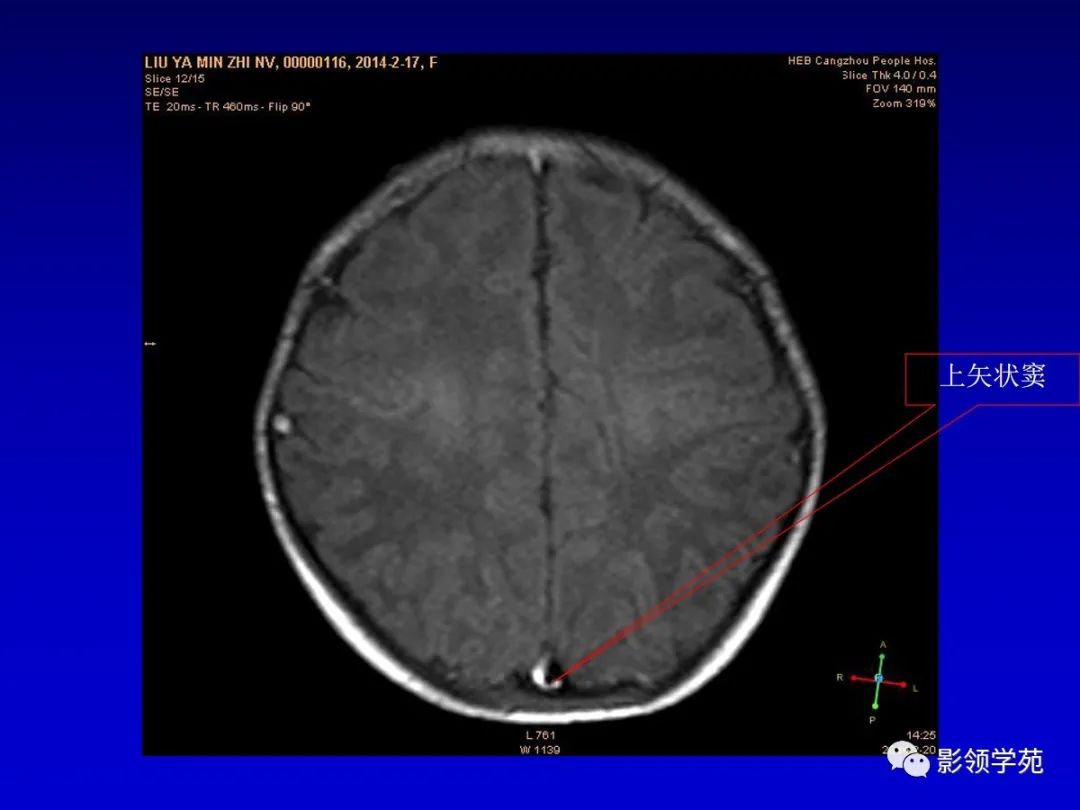影像PPT - 新生儿颅脑MRI解剖及常见疾病影像表现-106 影像PPT - 新生儿颅脑MRI解剖及常见疾病影像表现-106