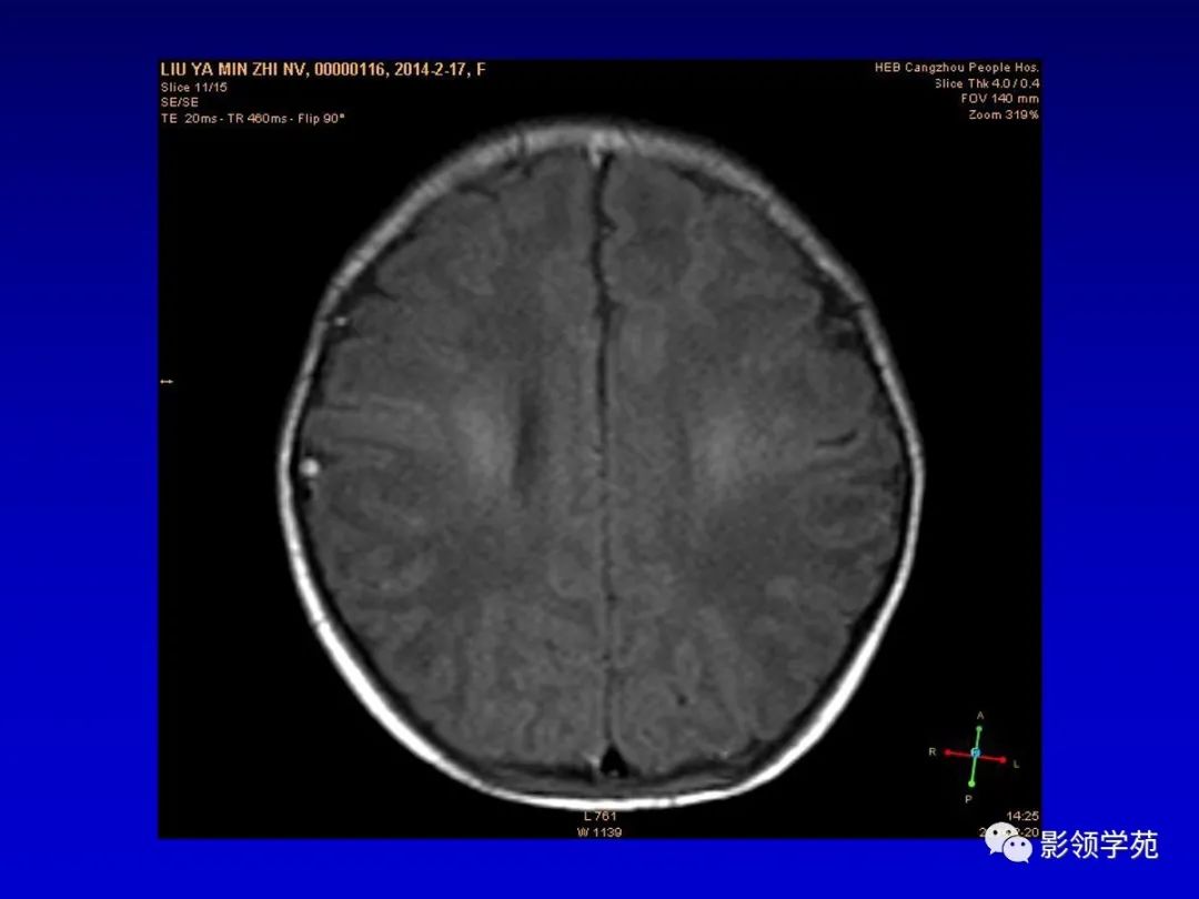 影像PPT - 新生儿颅脑MRI解剖及常见疾病影像表现-107 影像PPT - 新生儿颅脑MRI解剖及常见疾病影像表现-107