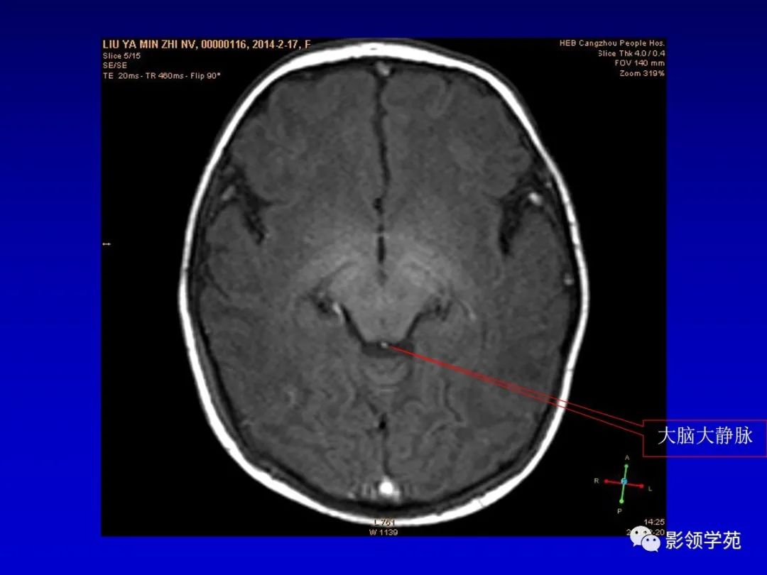 影像PPT - 新生儿颅脑MRI解剖及常见疾病影像表现-113 影像PPT - 新生儿颅脑MRI解剖及常见疾病影像表现-113