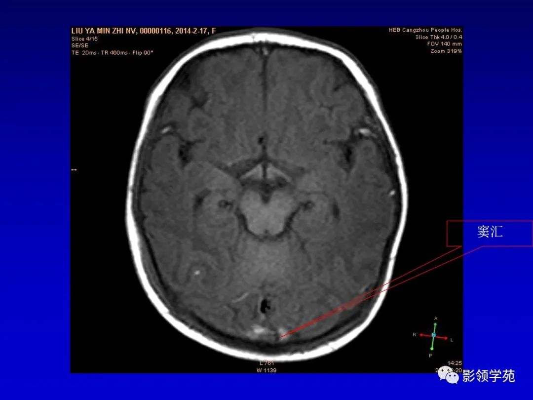 影像PPT - 新生儿颅脑MRI解剖及常见疾病影像表现-114 影像PPT - 新生儿颅脑MRI解剖及常见疾病影像表现-114