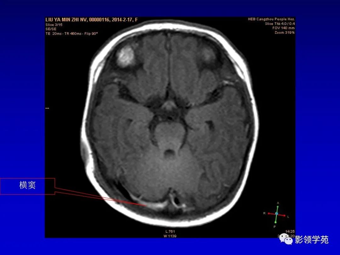 影像PPT - 新生儿颅脑MRI解剖及常见疾病影像表现-115 影像PPT - 新生儿颅脑MRI解剖及常见疾病影像表现-115