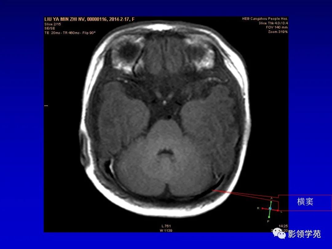 影像PPT - 新生儿颅脑MRI解剖及常见疾病影像表现-116 影像PPT - 新生儿颅脑MRI解剖及常见疾病影像表现-116