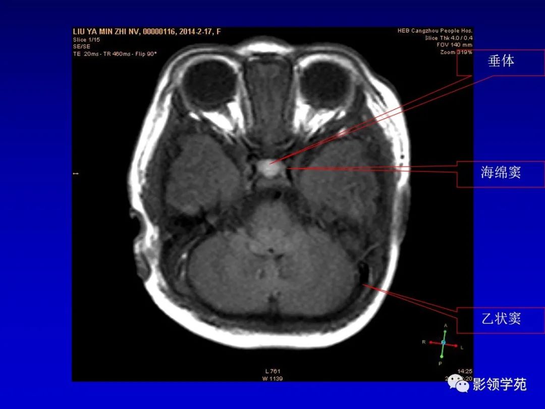 影像PPT - 新生儿颅脑MRI解剖及常见疾病影像表现-117 影像PPT - 新生儿颅脑MRI解剖及常见疾病影像表现-117