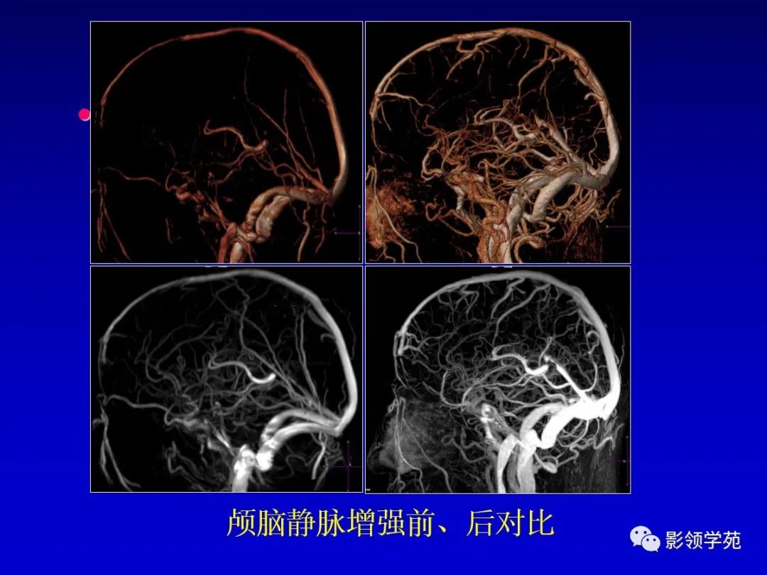影像PPT - 新生儿颅脑MRI解剖及常见疾病影像表现-119 影像PPT - 新生儿颅脑MRI解剖及常见疾病影像表现-119