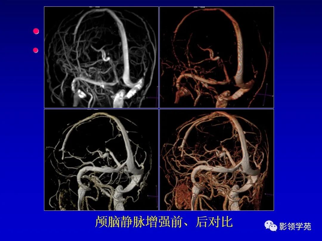 影像PPT - 新生儿颅脑MRI解剖及常见疾病影像表现-120 影像PPT - 新生儿颅脑MRI解剖及常见疾病影像表现-120