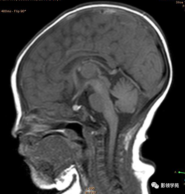 影像PPT - 新生儿颅脑MRI解剖及常见疾病影像表现-135 影像PPT - 新生儿颅脑MRI解剖及常见疾病影像表现-135
