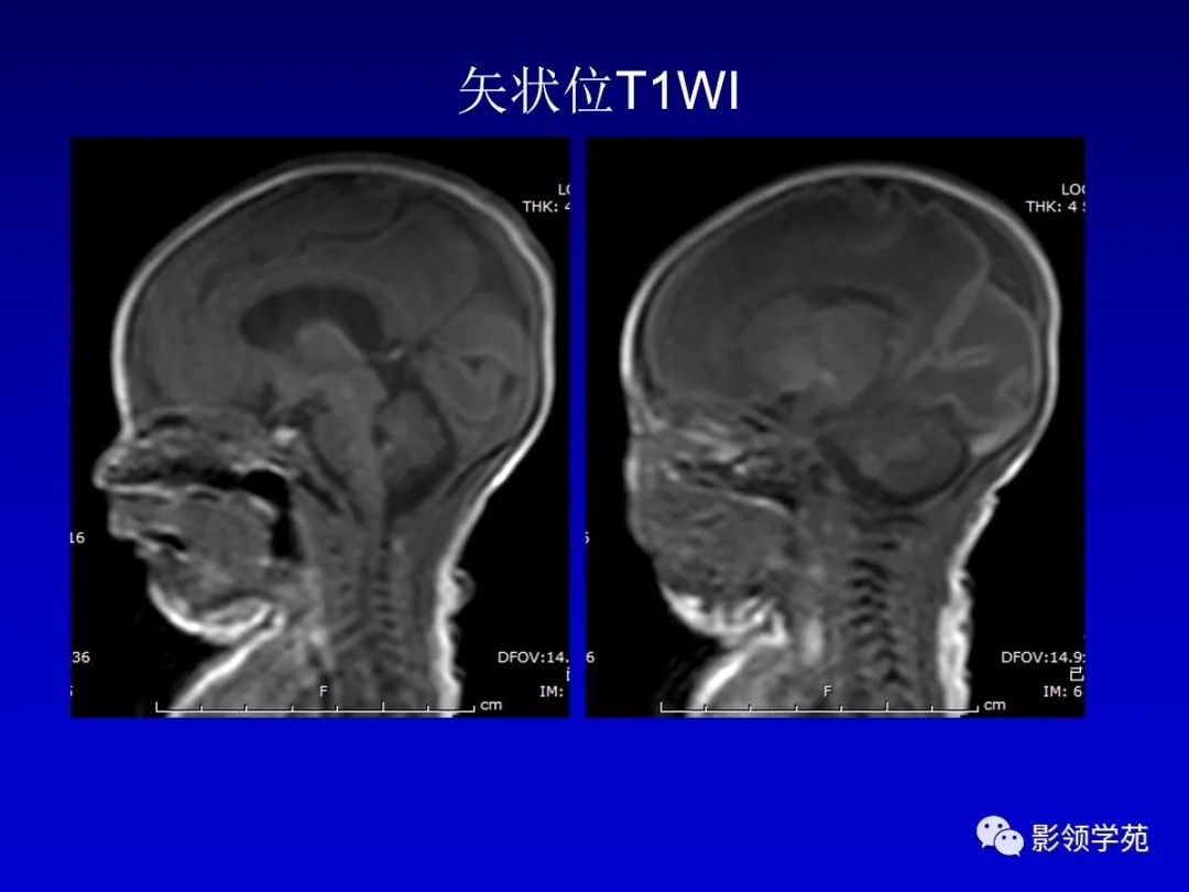 影像PPT - 新生儿颅脑MRI解剖及常见疾病影像表现-153 影像PPT - 新生儿颅脑MRI解剖及常见疾病影像表现-153