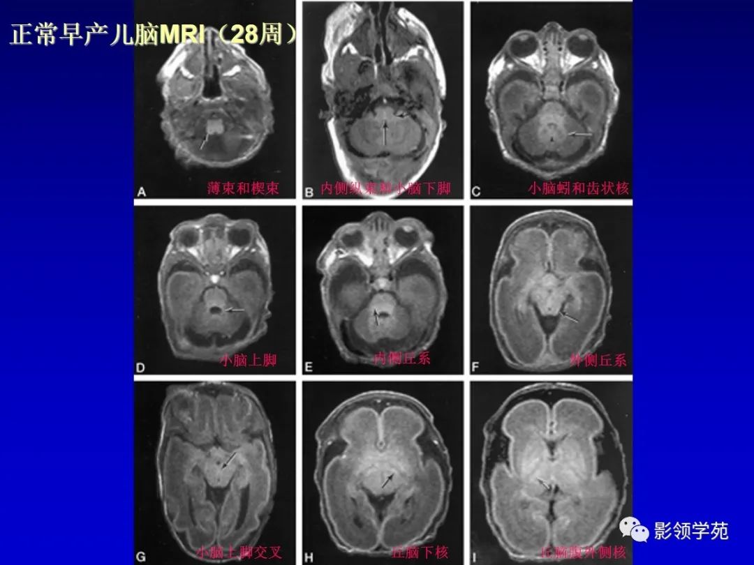 影像PPT - 新生儿颅脑MRI解剖及常见疾病影像表现-154 影像PPT - 新生儿颅脑MRI解剖及常见疾病影像表现-154
