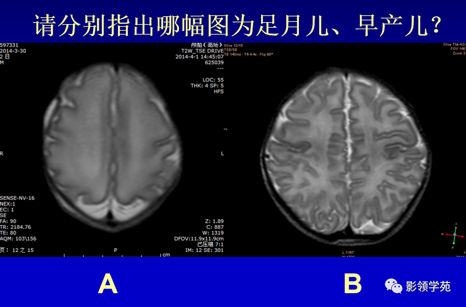 影像PPT - 新生儿颅脑MRI解剖及常见疾病影像表现-157 影像PPT - 新生儿颅脑MRI解剖及常见疾病影像表现-157