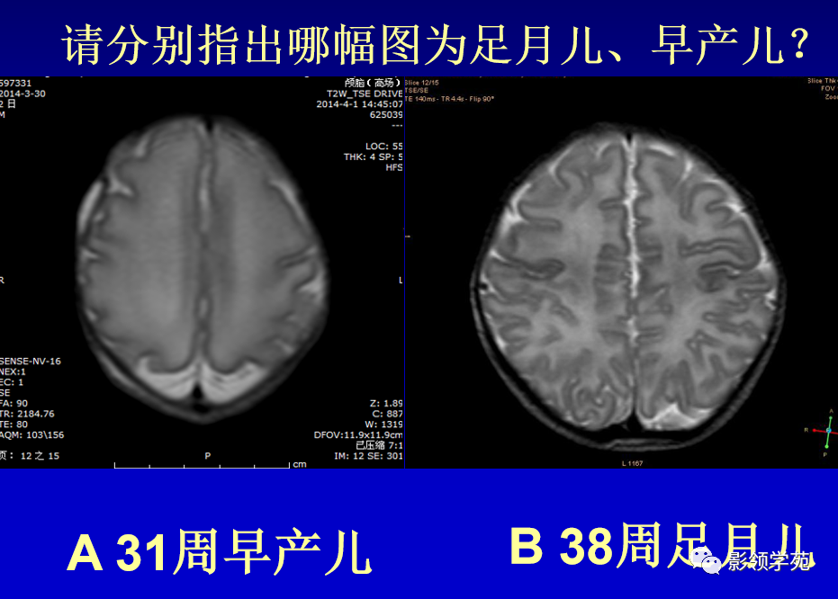 影像PPT - 新生儿颅脑MRI解剖及常见疾病影像表现-158 影像PPT - 新生儿颅脑MRI解剖及常见疾病影像表现-158
