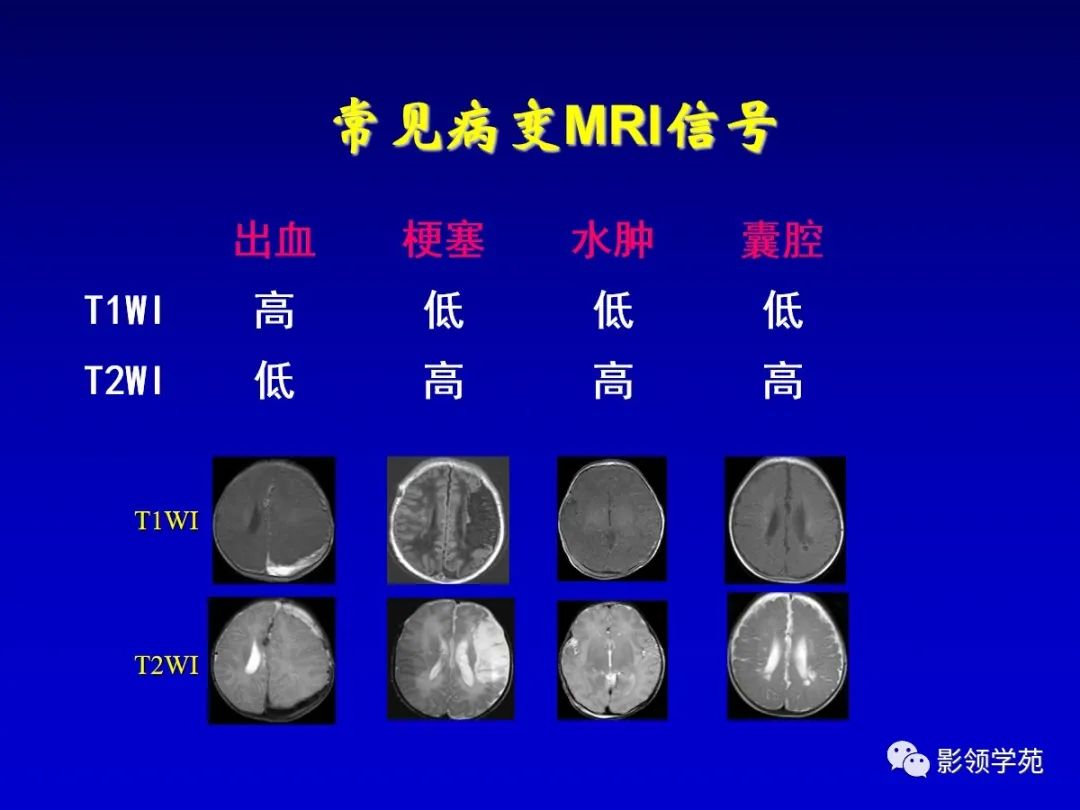 影像PPT - 新生儿颅脑MRI解剖及常见疾病影像表现-161 影像PPT - 新生儿颅脑MRI解剖及常见疾病影像表现-161