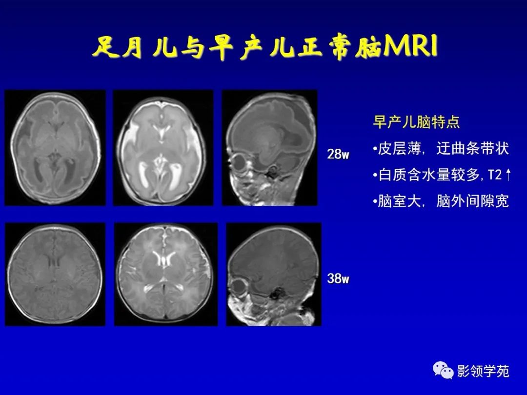 影像PPT - 新生儿颅脑MRI解剖及常见疾病影像表现-162 影像PPT - 新生儿颅脑MRI解剖及常见疾病影像表现-162