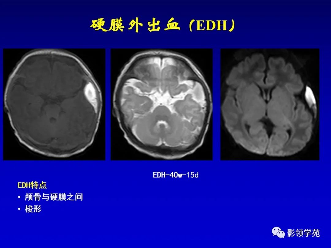 影像PPT - 新生儿颅脑MRI解剖及常见疾病影像表现-165 影像PPT - 新生儿颅脑MRI解剖及常见疾病影像表现-165