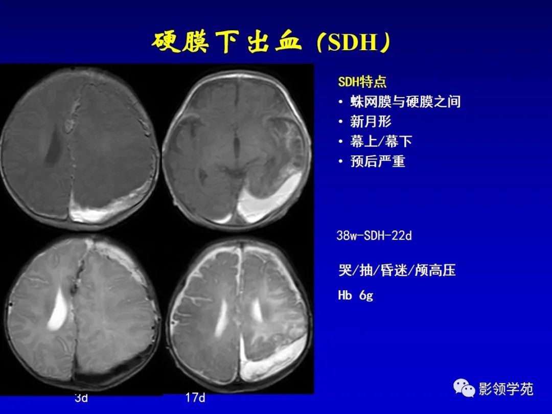 影像PPT - 新生儿颅脑MRI解剖及常见疾病影像表现-166 影像PPT - 新生儿颅脑MRI解剖及常见疾病影像表现-166