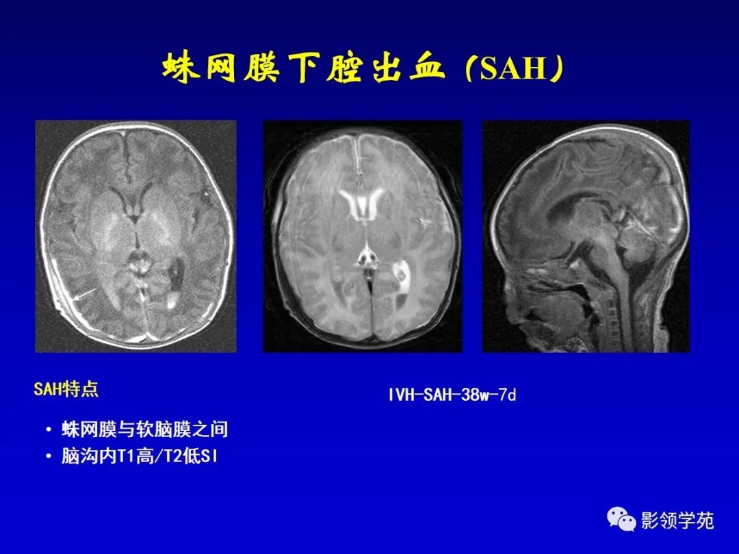 影像PPT - 新生儿颅脑MRI解剖及常见疾病影像表现-167 影像PPT - 新生儿颅脑MRI解剖及常见疾病影像表现-167