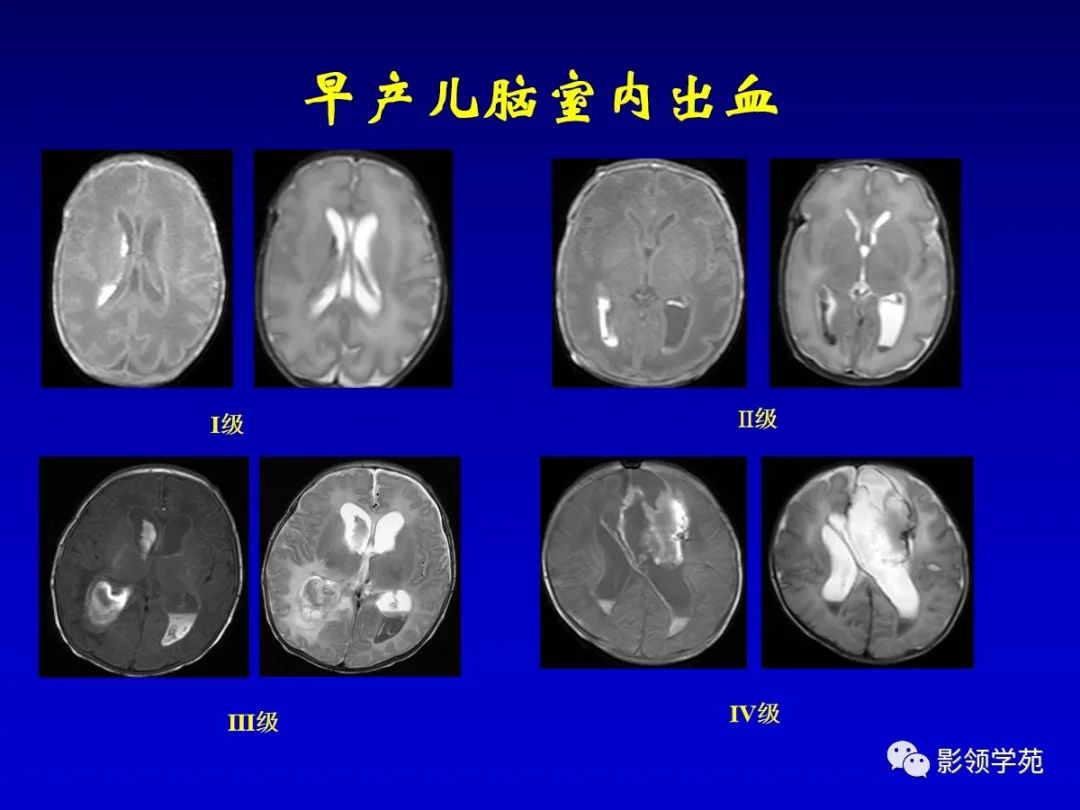 影像PPT - 新生儿颅脑MRI解剖及常见疾病影像表现-169 影像PPT - 新生儿颅脑MRI解剖及常见疾病影像表现-169
