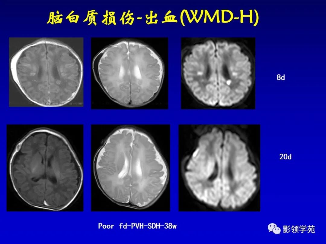 影像PPT - 新生儿颅脑MRI解剖及常见疾病影像表现-172 影像PPT - 新生儿颅脑MRI解剖及常见疾病影像表现-172