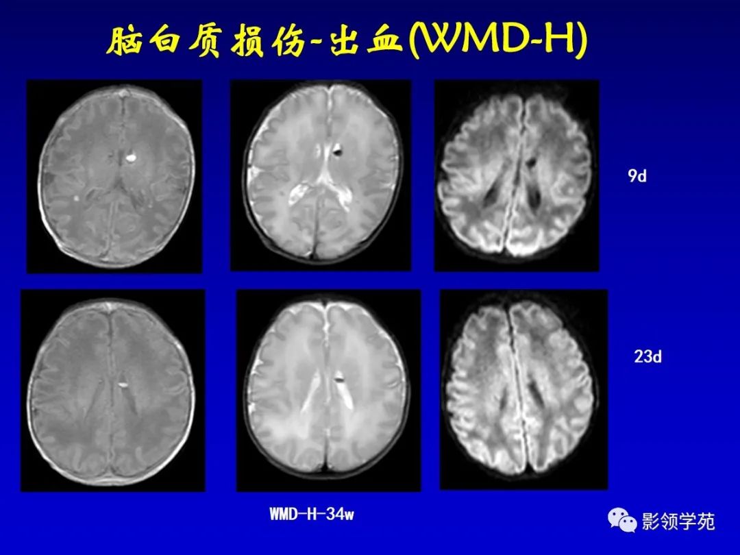 影像PPT - 新生儿颅脑MRI解剖及常见疾病影像表现-173 影像PPT - 新生儿颅脑MRI解剖及常见疾病影像表现-173