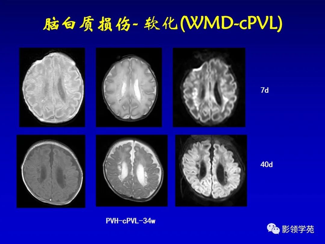影像PPT - 新生儿颅脑MRI解剖及常见疾病影像表现-174 影像PPT - 新生儿颅脑MRI解剖及常见疾病影像表现-174