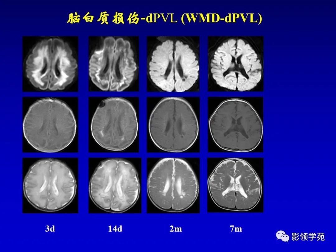 影像PPT - 新生儿颅脑MRI解剖及常见疾病影像表现-175 影像PPT - 新生儿颅脑MRI解剖及常见疾病影像表现-175