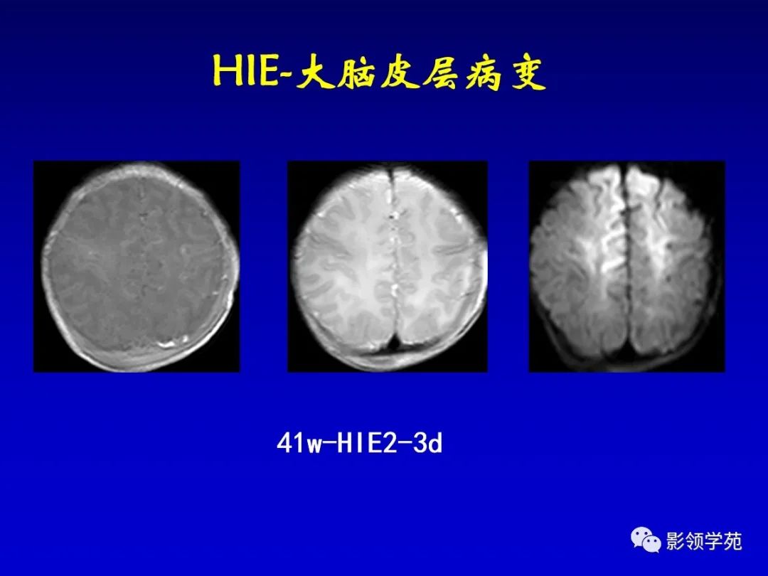 影像PPT - 新生儿颅脑MRI解剖及常见疾病影像表现-179 影像PPT - 新生儿颅脑MRI解剖及常见疾病影像表现-179
